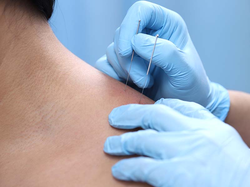Dry needling - patient gets treatment on his shoulder